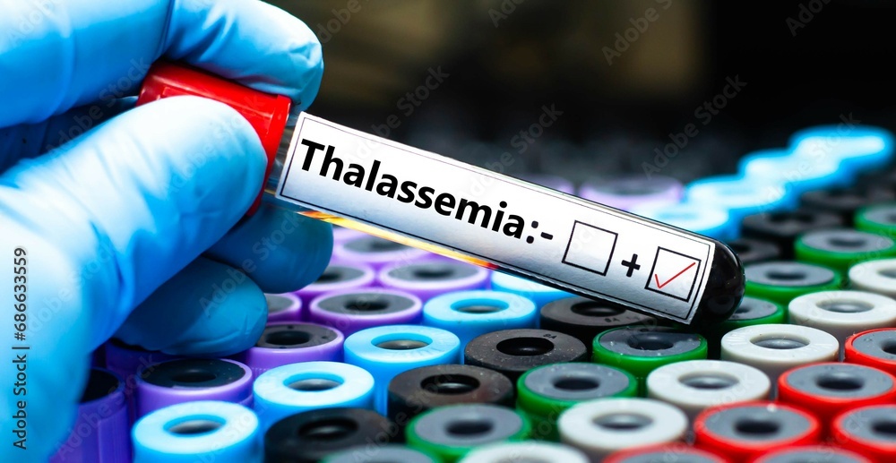 Fototapeta premium Blood sample of patient positive tested for thalassemia.