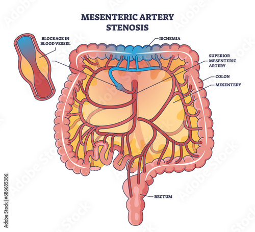 Mesenteric artery stenosis as blockage in blood vessel outline diagram. Labeled educational scheme with dangerous medical condition for abdomen and digestive tract health vector illustration.