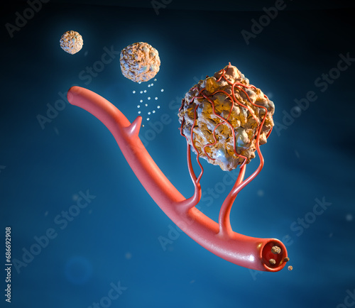 Angiogenesis in tumor growth photo