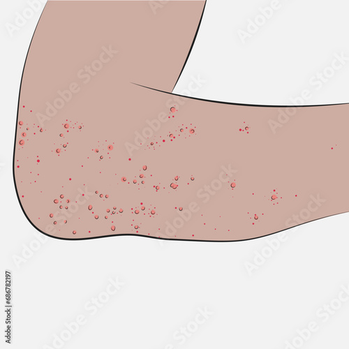 Rash, dermatitis or skin rash; It is an area of skin that is inflamed or irritated and usually itchy.