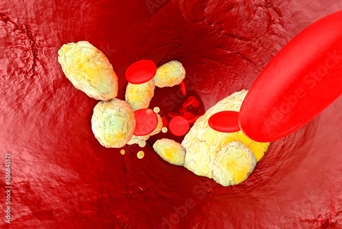 3D Rendered illustration, visualisation of fat clogging a artery and forming the sickness arteriosclerosis photo