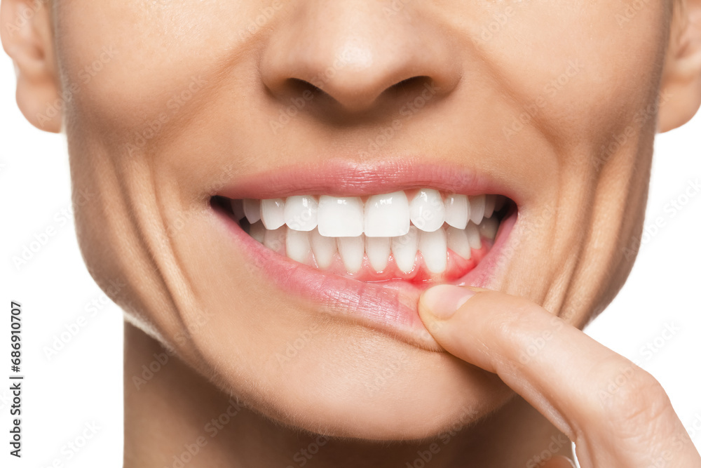 Woman showing inflamed gum on white background, closeup Woman showing inflamed gum on white background, closeup