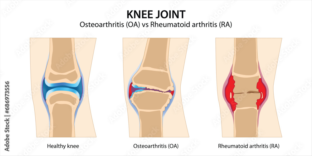 Knee Joint Osteoarthritis vs Rheumatoid arthritis - obrazy, fototapety, plakaty 