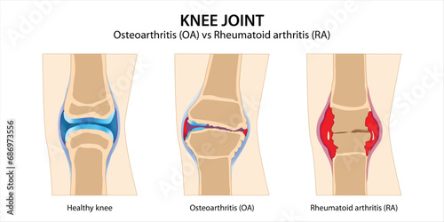 Knee Joint Osteoarthritis vs Rheumatoid arthritis photo