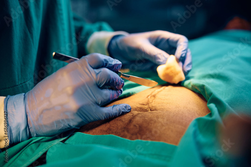 Close up of surgeon using scalpel while making incision on patient's abdomen in operating room. photo