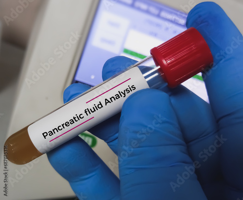 Biochemist or medical technologist hold Pancreatic cyst fluid analysis sample, Ascites. photo