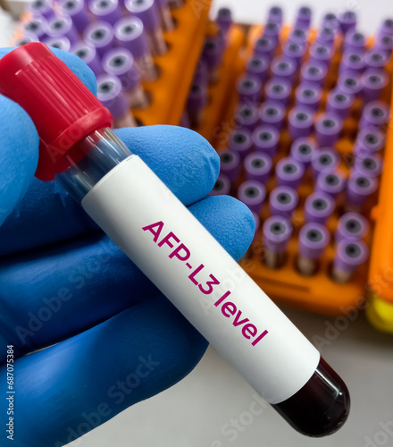 Blood sample for Alpha-fetoprotein (AFP) total and L3 level testing, for use in the assessment of risk for the development of hepatocellular carcinoma (HCC) in patients with chronic liver diseases. photo