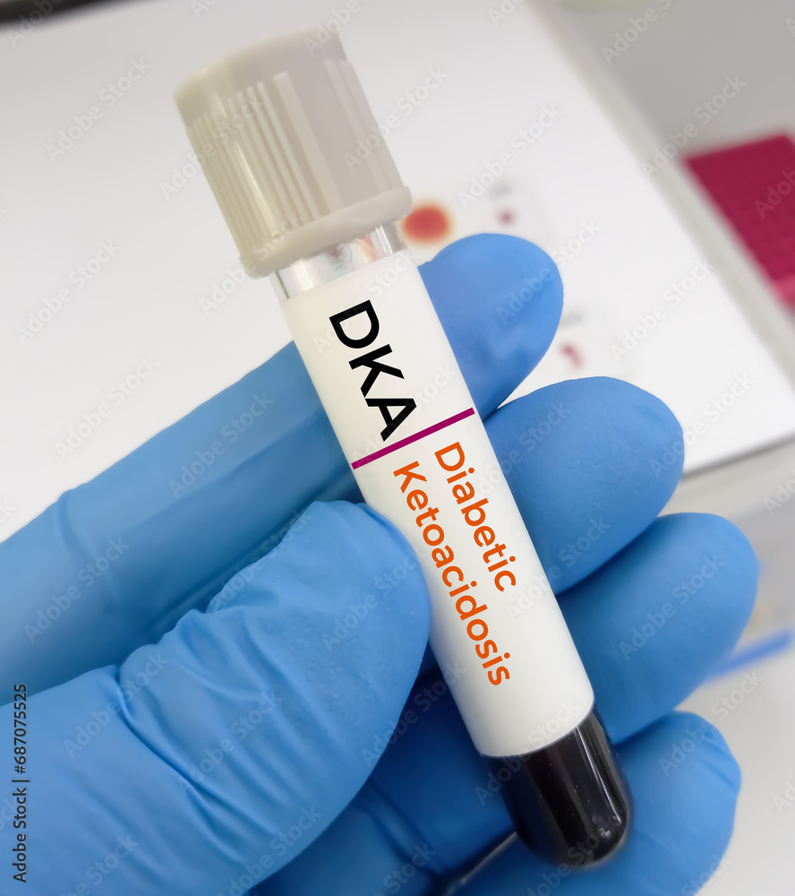 Blood sample for diabetic ketoacidosis (DKA) test. A complication of diabetes that can lead to a coma or even death. life-threatening problem. Blood sample for diabetic ketoacidosis (DKA) test. A complication of diabetes that can lead to a coma or even death. life-threatening problem.