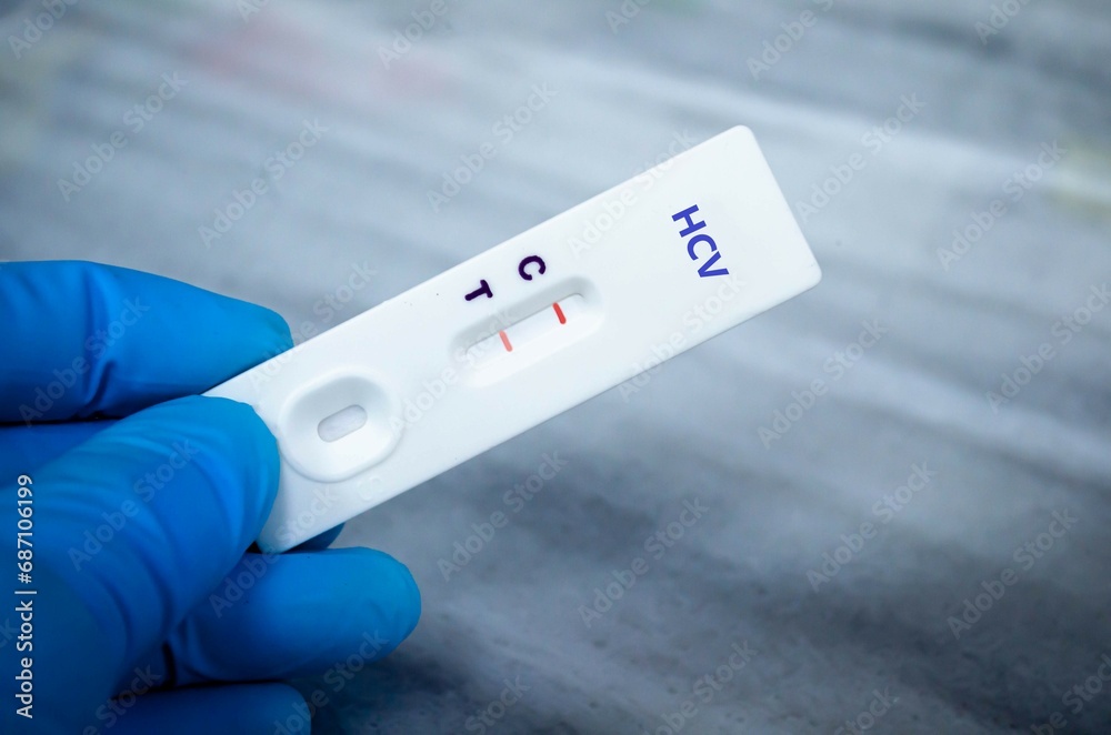 Blood sample of patient positive tested for anti-HCV by rapid diagnostic test. Blood sample of patient positive tested for anti-HCV by rapid diagnostic test.