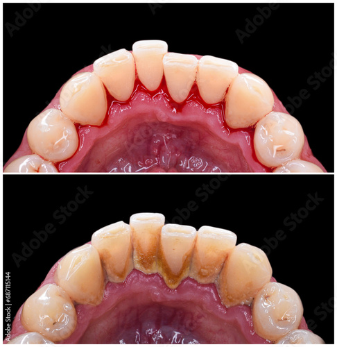 Fotografia teeth deep cleaning before and after picture