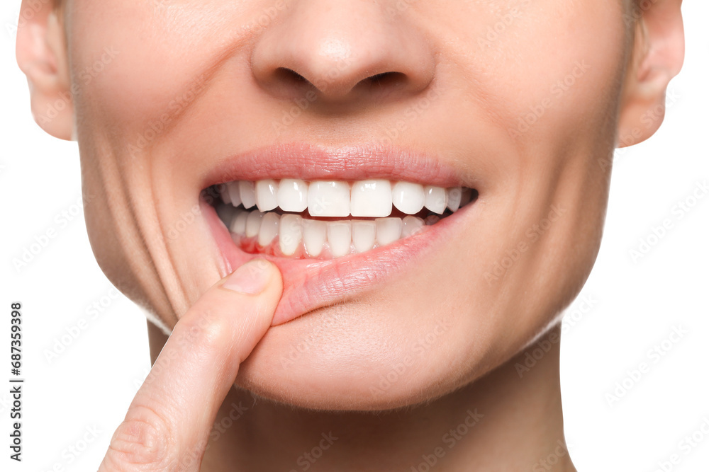 Woman showing inflamed gum on white background, closeup Woman showing inflamed gum on white background, closeup