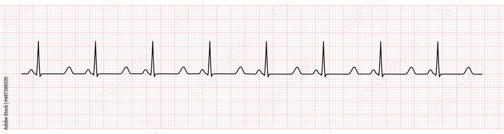 EKG Monitor Showing Sinus Rhythm with prolong QT interval EKG Monitor Showing Sinus Rhythm with prolong QT interval