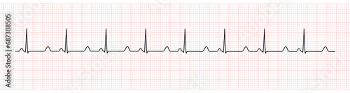 EKG Monitor Showing  Sinus Rhythm with prolong QT interval photo