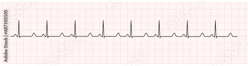 EKG Monitor Showing  Sinus Rhythm with prolong QT interval