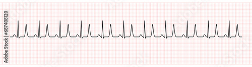 EKG Monitor Showing  Sinus Rhythm with Tall T Wave Represented Hyperkalemia