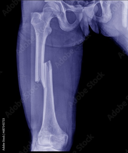 X-ray images of the femur showed a central fracture.