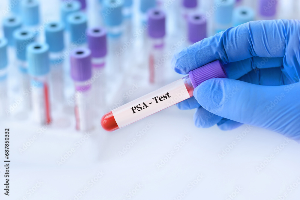Doctor holding a test blood sample tube with PSA Prostate Specific Antigen test on the background of medical test tubes with analyzes Doctor holding a test blood sample tube with PSA Prostate Specific Antigen test on the background of medical test tubes with analyzes