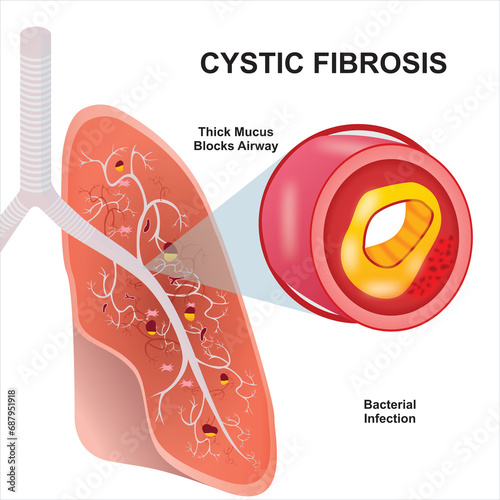 Cystic fibrosis illustration infection on lungs photo
