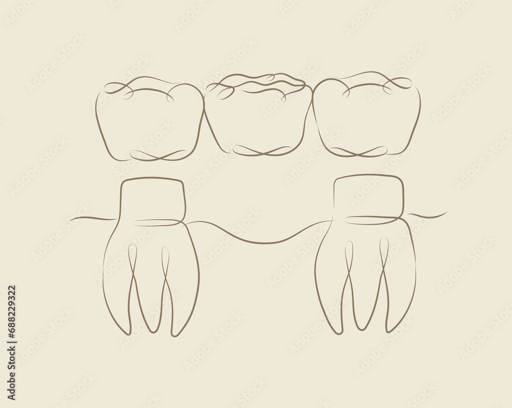 Teeth with crown bridge illustration drawing in linear style on beige background