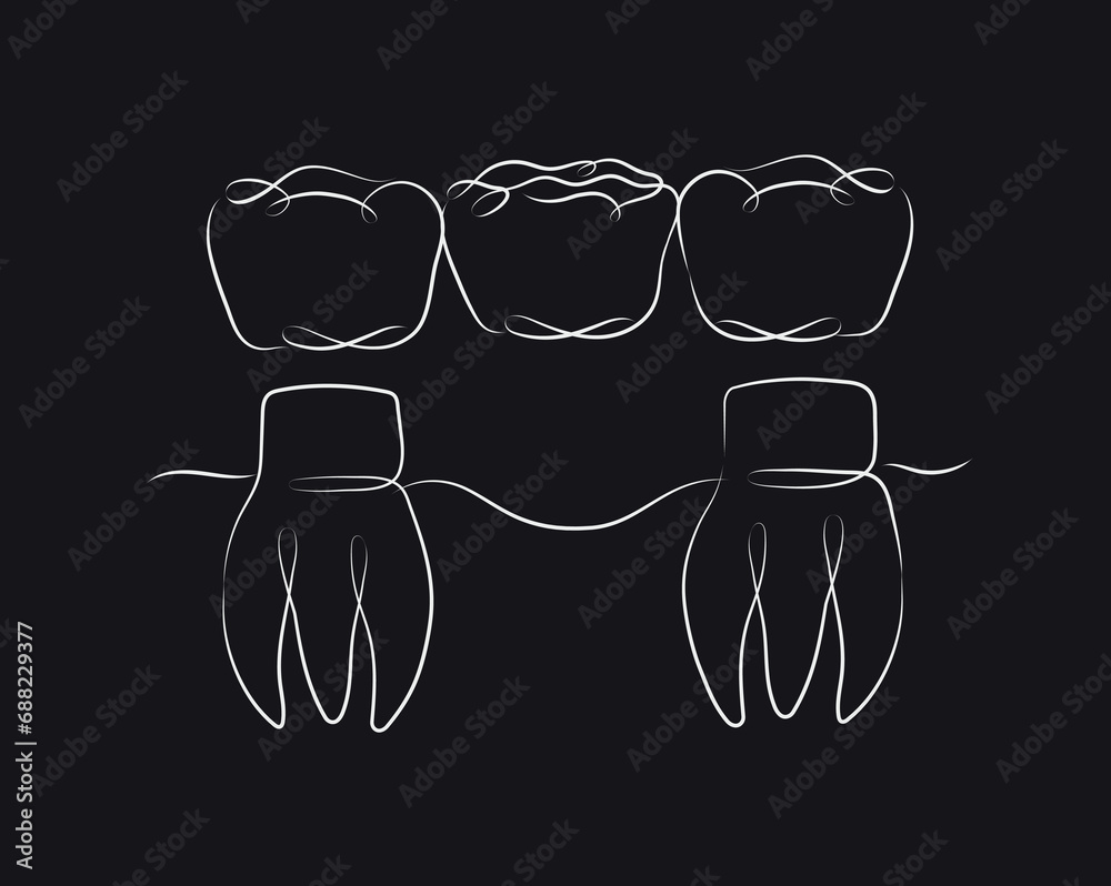 Teeth with crown bridge illustration drawing in linear style on black background