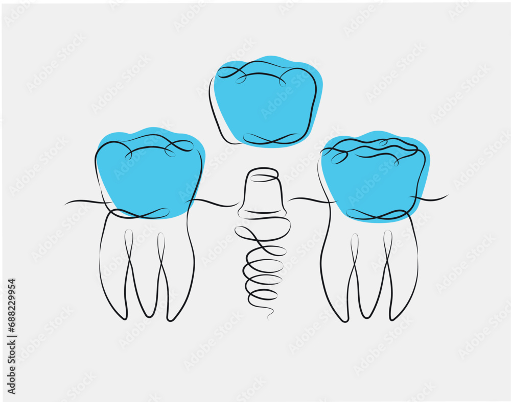 Teeth implant illustration drawing in linear style on white and blue background