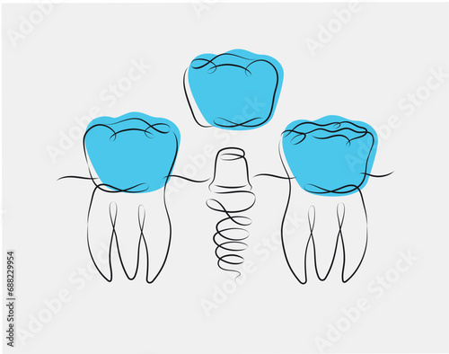 Obraz na płótnie Teeth implant illustration drawing in linear style on white and blue background w salonie