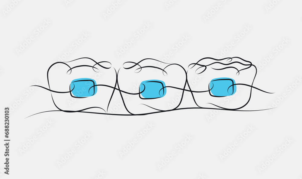 Teeth braces illustration drawing in linear style on white and blue background