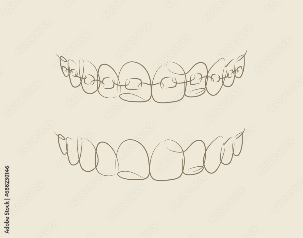 Jaws with and without braces installed drawing in linear style on beige background