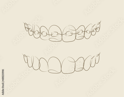 Obraz na płótnie Jaws with and without braces installed drawing in linear style on beige background w salonie