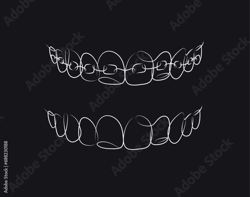 Obraz na płótnie Jaws with and without braces installed drawing in linear style on black background w salonie
