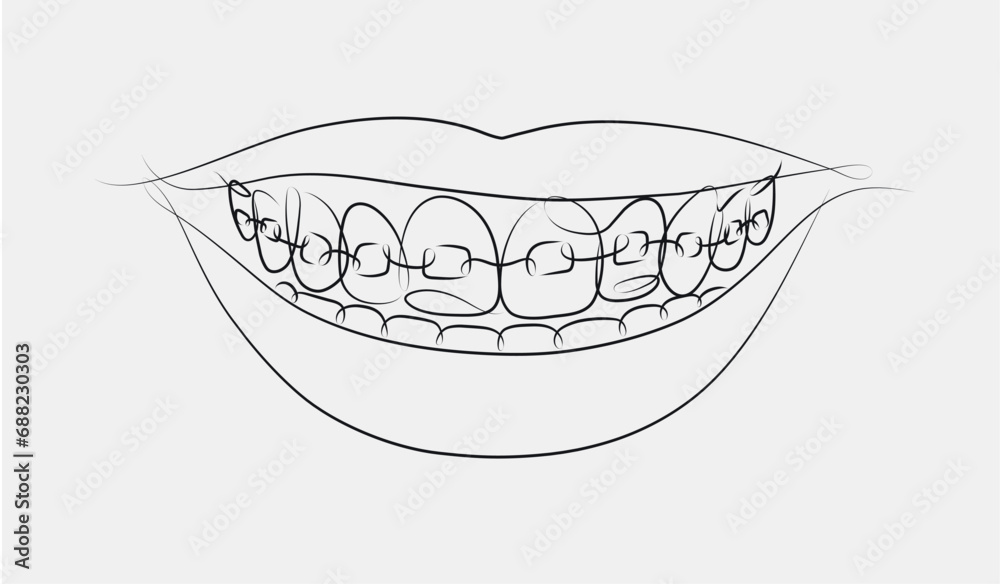 Smile with teeth braces in linear style drawing on white background