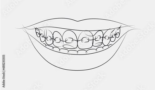 Obraz na płótnie Smile with teeth braces in linear style drawing on white background w salonie
