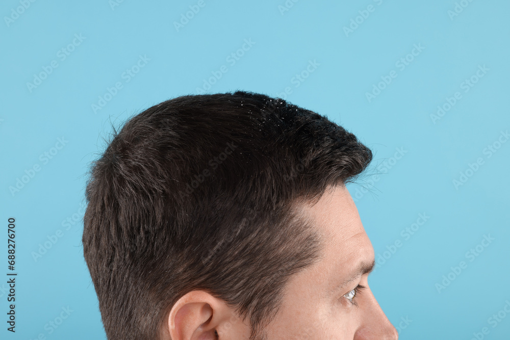 Obraz premium Man with dandruff in his dark hair on light blue background, closeup