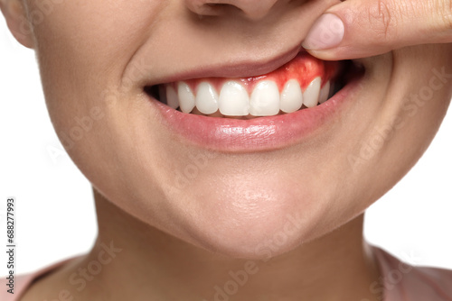 Woman showing inflamed gum on white background  closeup