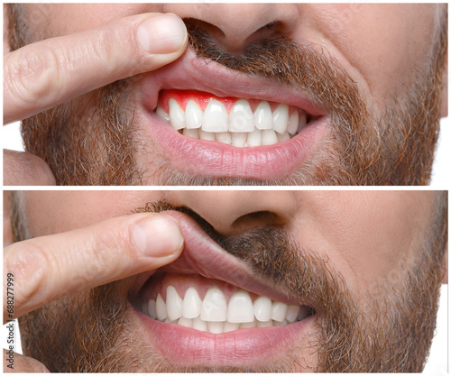 Man showing gum before and after treatment  collage of photos
