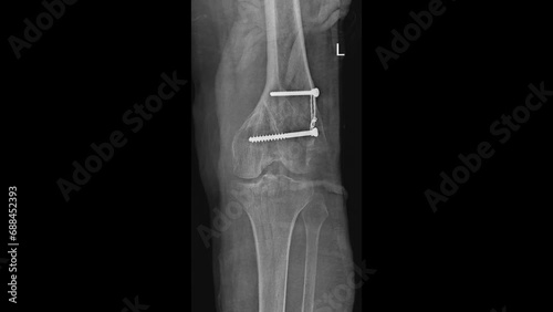 Distal femur fracture fixation radiograph  photo