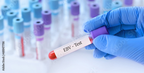 Fotografie Doctor holding a test blood sample tube with Epstein-Barr Virus (EBV) test on th