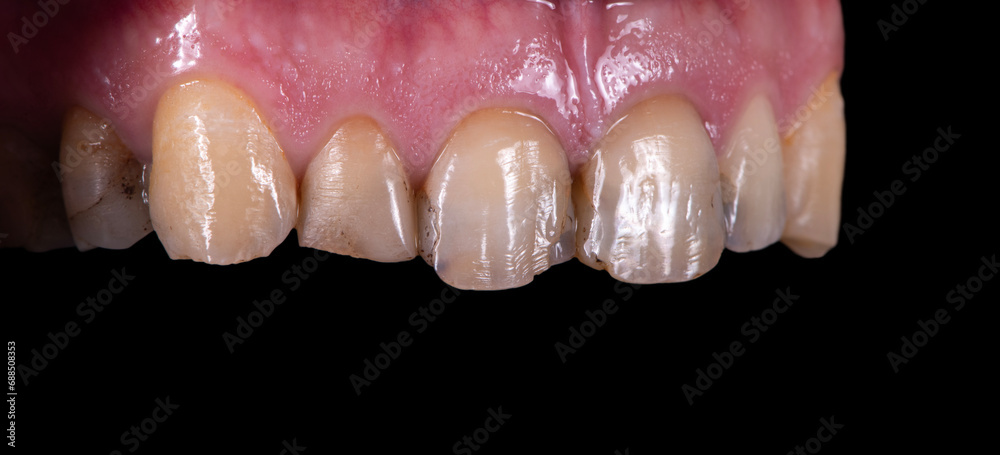 Obraz premium emax crowns and veneers