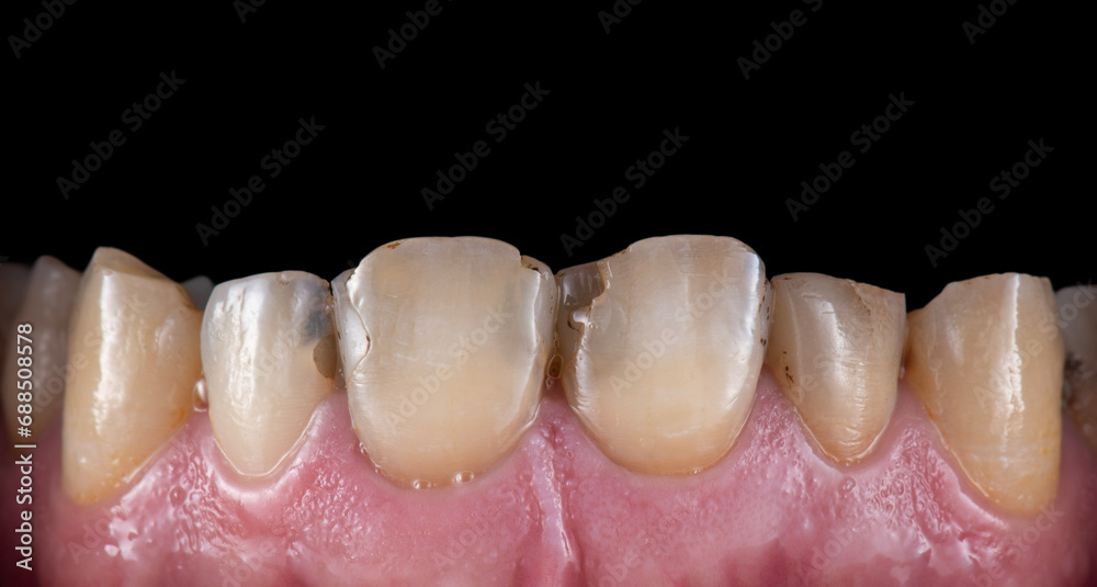 Obraz premium emax crowns and veneers
