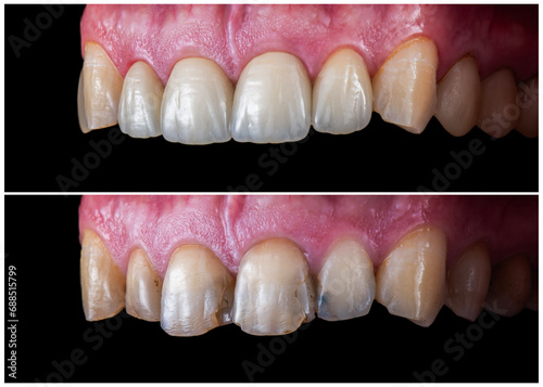 emax crowns and veneers