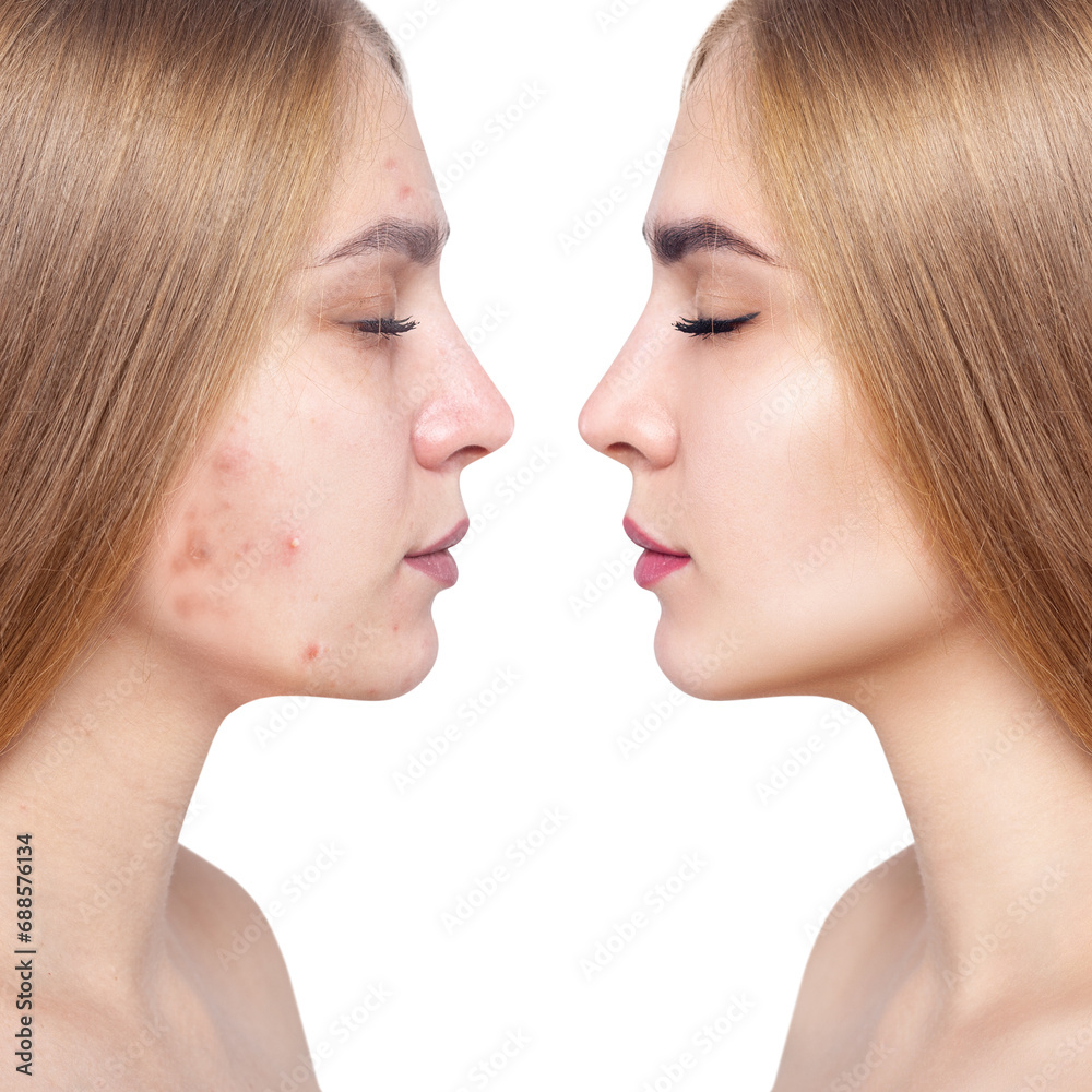 Young woman before and after acne treatment and makeup. Young woman before and after acne treatment and makeup.