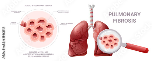 Alveoli in pulmonary fibrosis under magnification. Vector illustration isolated on white background photo