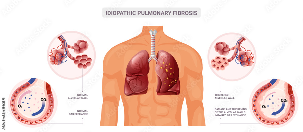 Normal lung and pulmonary fibrosis diagram. Vector illustration isolated on white background - obrazy, fototapety, plakaty 
