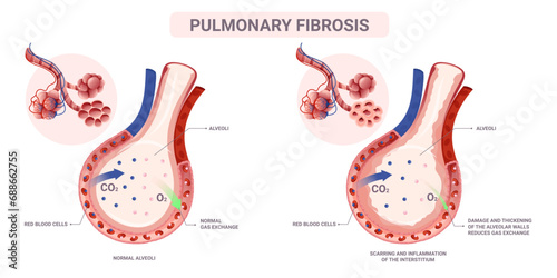 Pulmonary fibrosis alveoli anatomy. Vector illustration isolated on white background