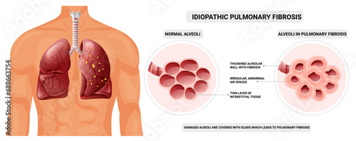 Normal lung and pulmonary fibrosis. Vector illustration isolated on white background