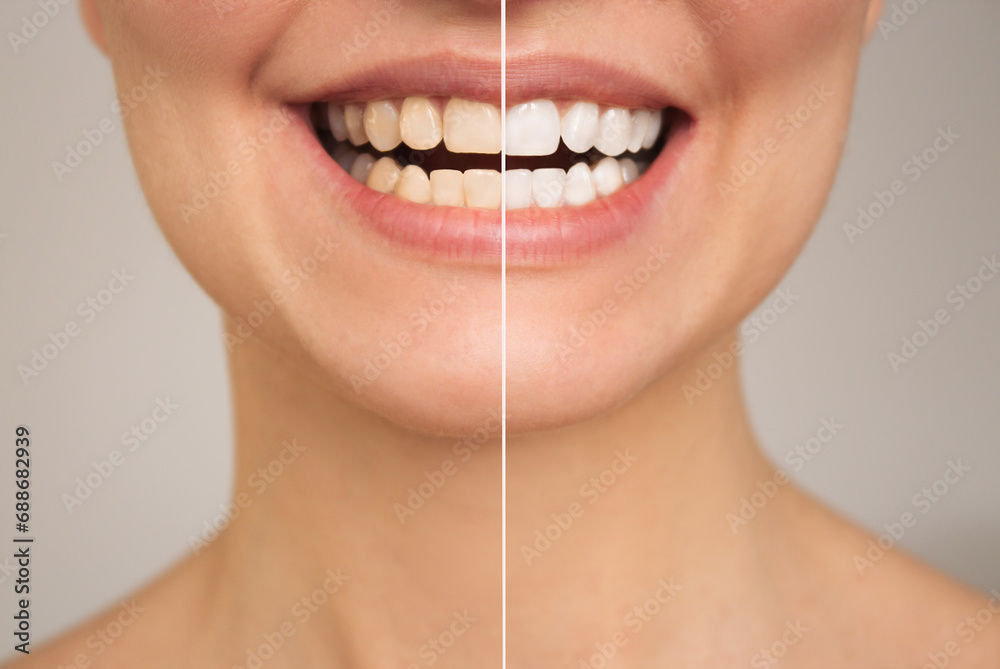 a close-up photo of women's teeth before and after whitening. The concept of comparison. Aesthetic dentistry. Dental care. Teeth whitening