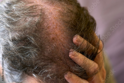 Close up of hand touching scalp with hair loss problem. 30 year old caucasian man with very thin hair worried about hair loss