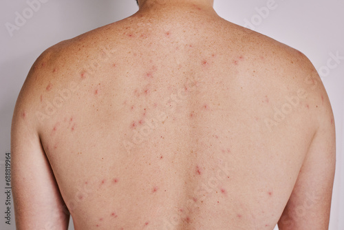 Man's back with acne, red spots, skin disease. Varicella or Herpes Zoster concept photo