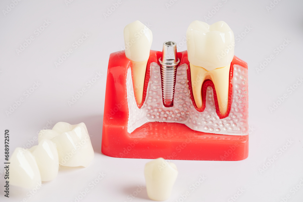 Obraz premium Dental implant, artificial tooth roots into jaw, root canal of dental treatment, gum disease, teeth model for dentist studying about dentistry.