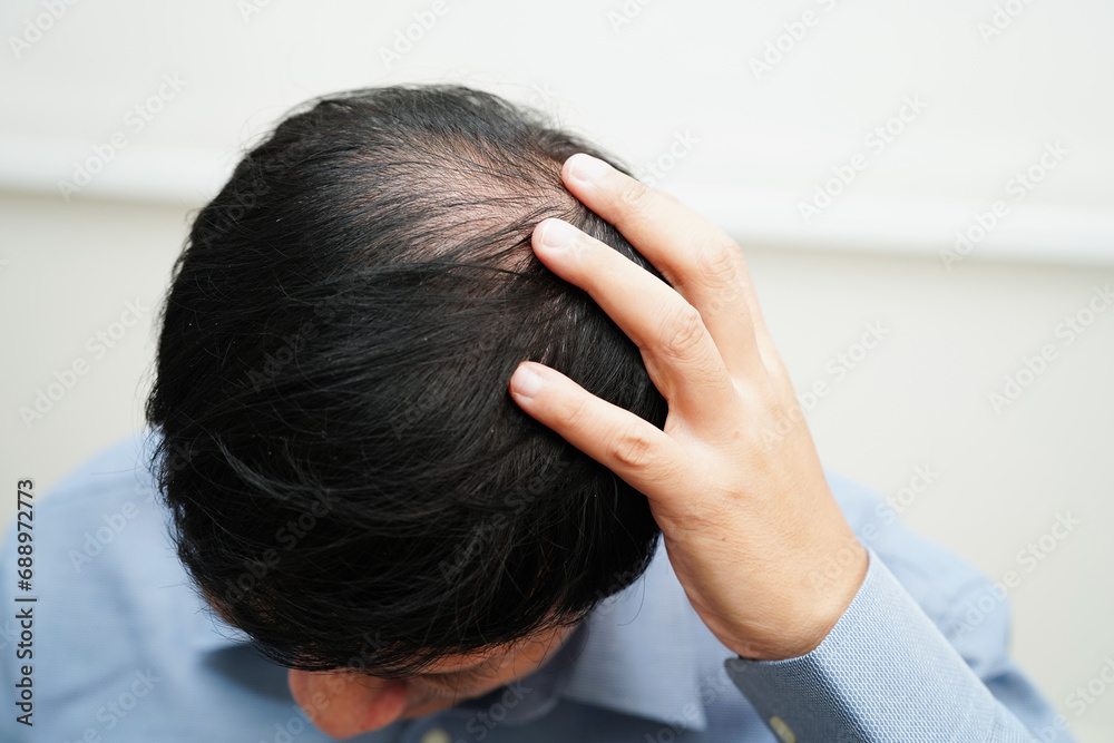Bald head in man, hair loss treatment health problem. Bald head in man, hair loss treatment health problem.